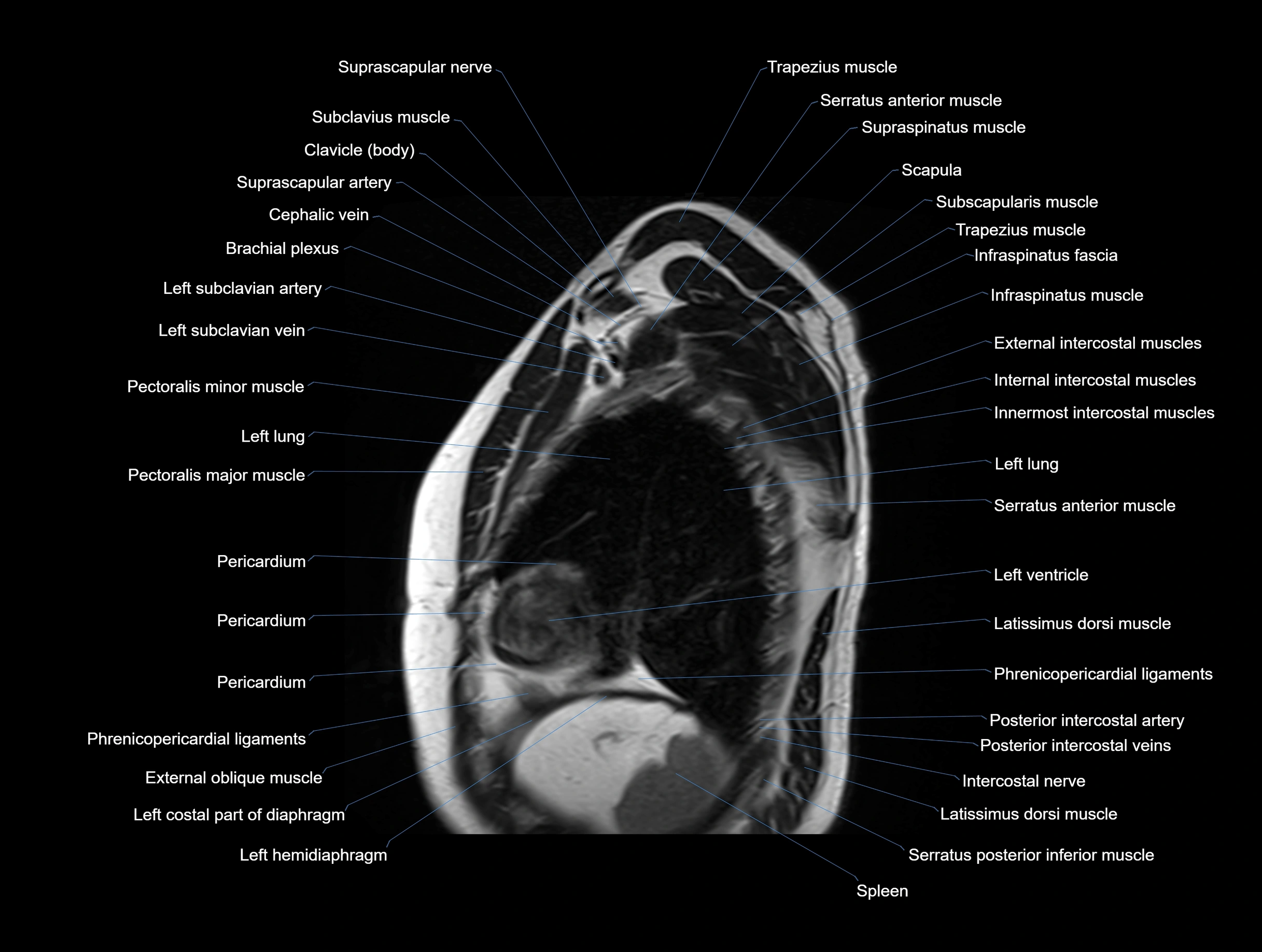 MRI chest (thorax) coronal  cross sectional anatomy 3T radiology  image-img-00001-00031.webp